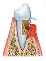 The Third Stage of Gum Disease is Advanced Periodontitis