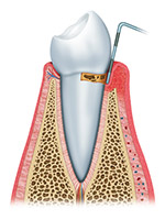 The First Stage of Gum Disease is Gingivitis