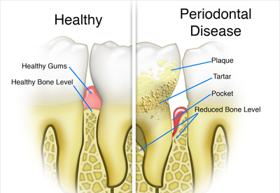 The Progression of Gum Disease