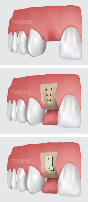 Dr. Davis Offers Bone Grafting Procedures