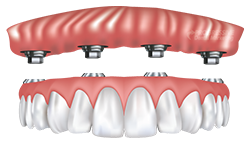 Dr. Davis Offers Dental Implant Dentures