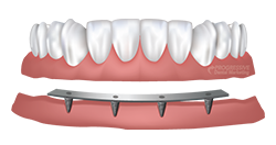 Dr. Davis Offers Dental Implant Dentures