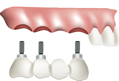 Dr. Davis Can Restore Multiple Missing Teeth