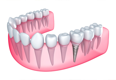 A model of a placed dental implant